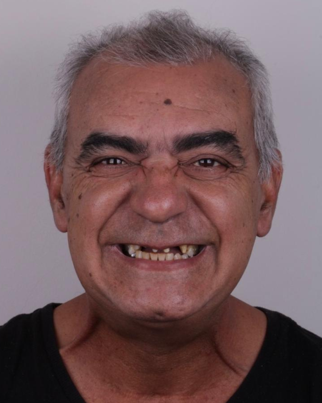 Implantes e Próteses (2)