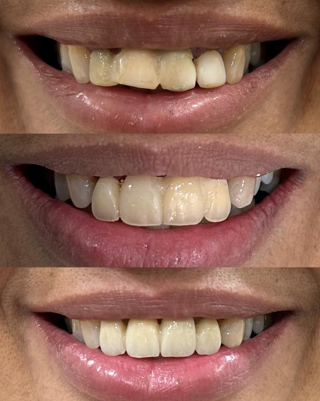 Implantes e Próteses (4)