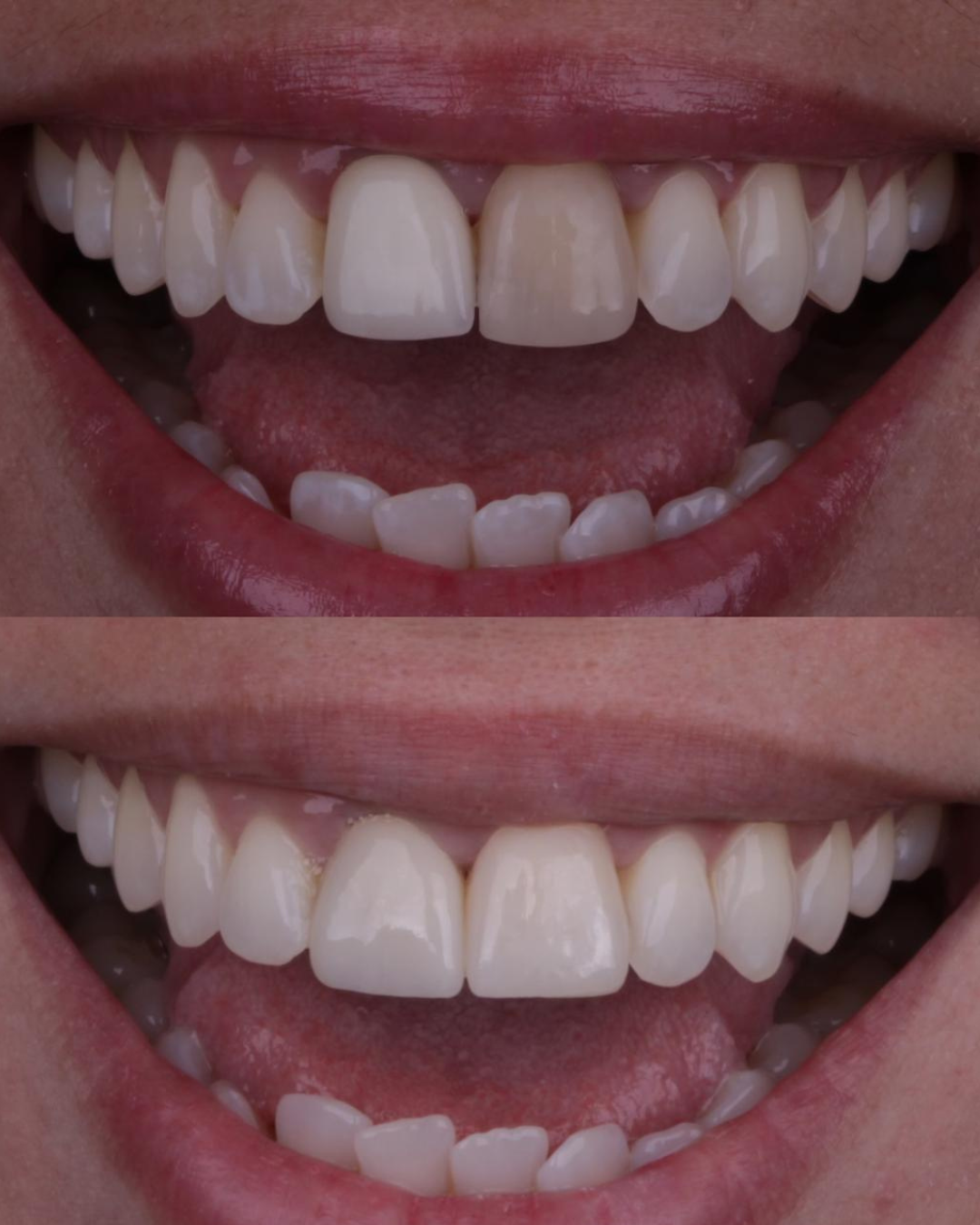 Implantes e Próteses (5)