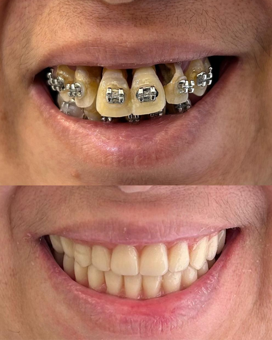 Implantes e Próteses (6)