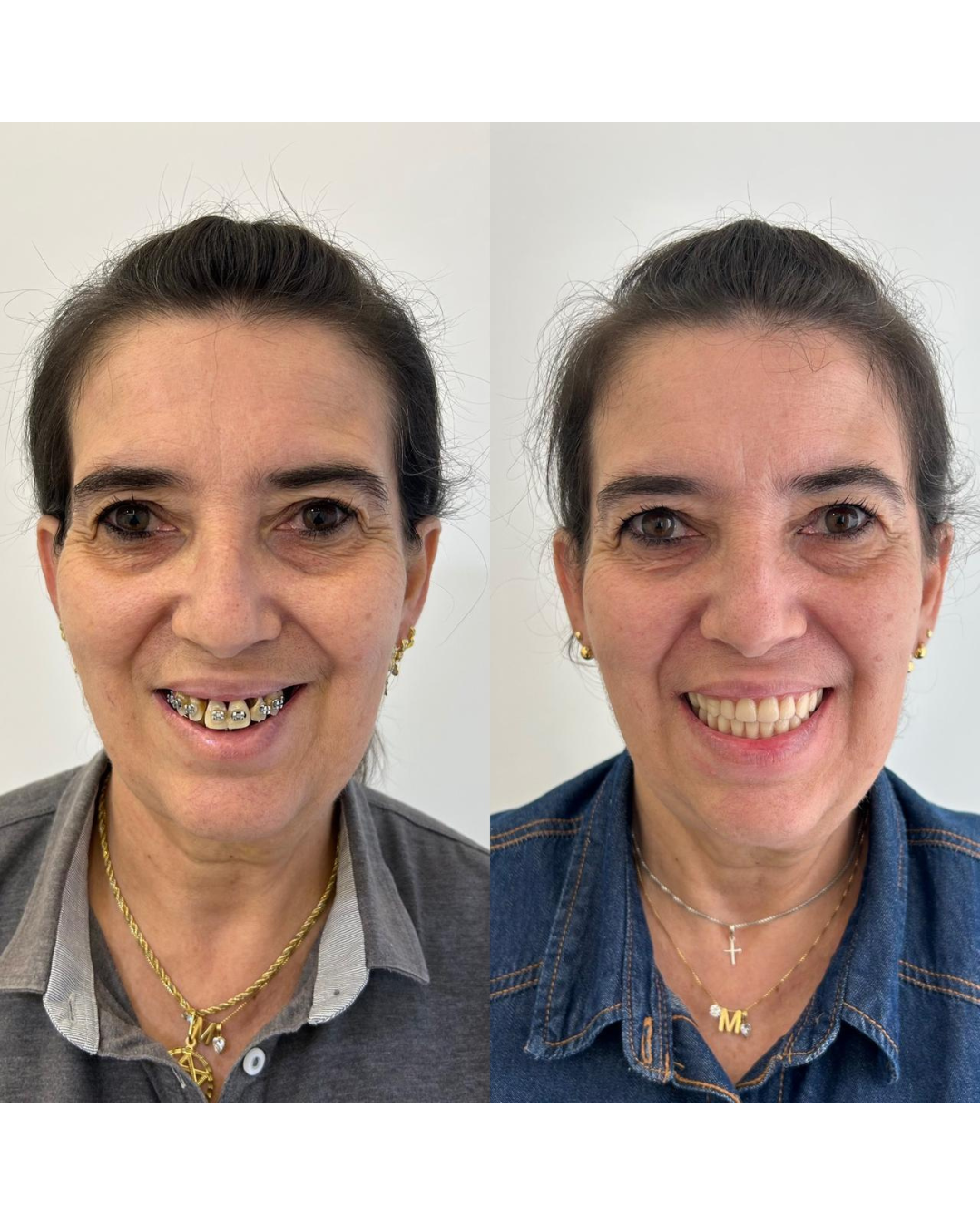 Implantes e Próteses (7)