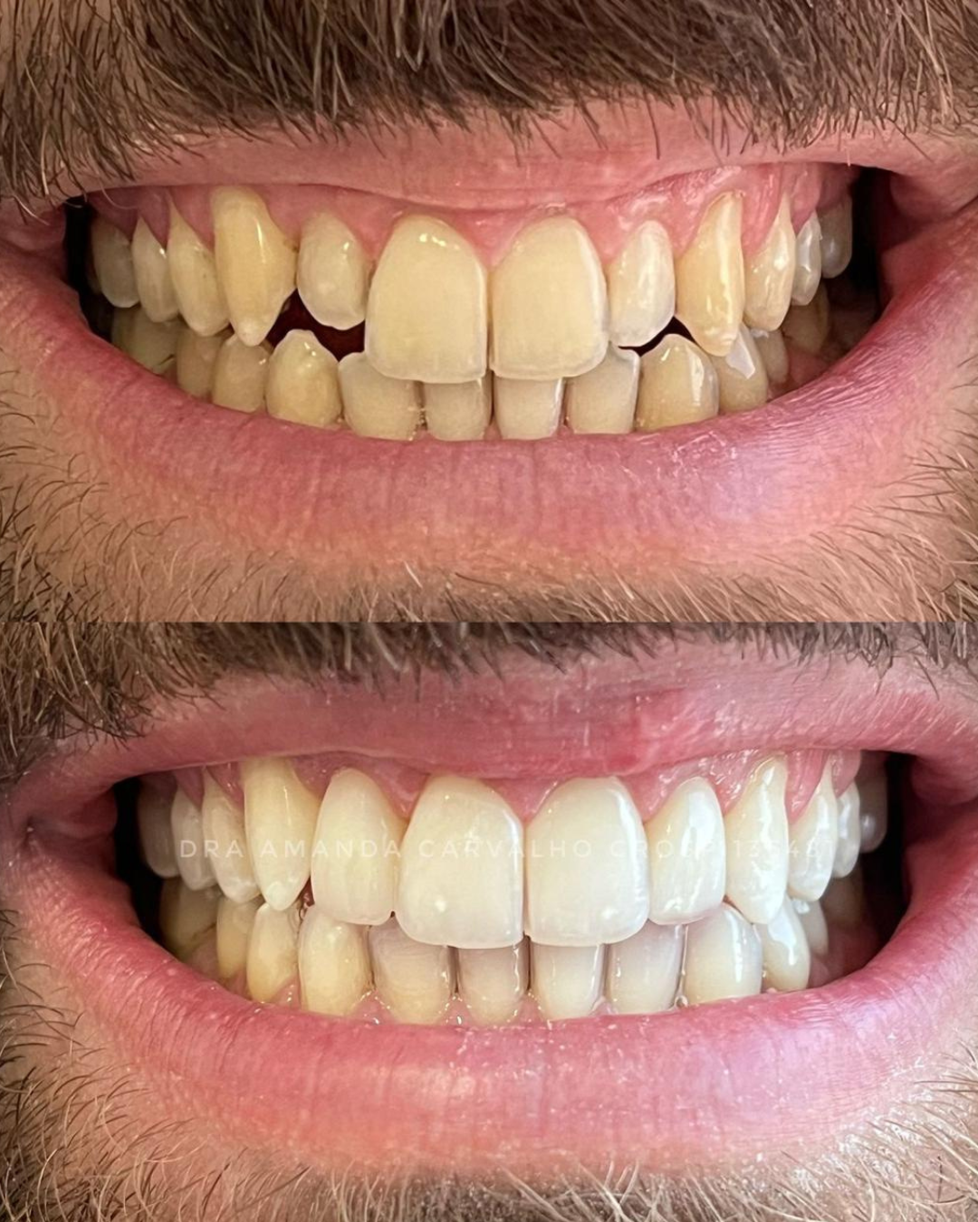 Lentes ImplanTOP (2)