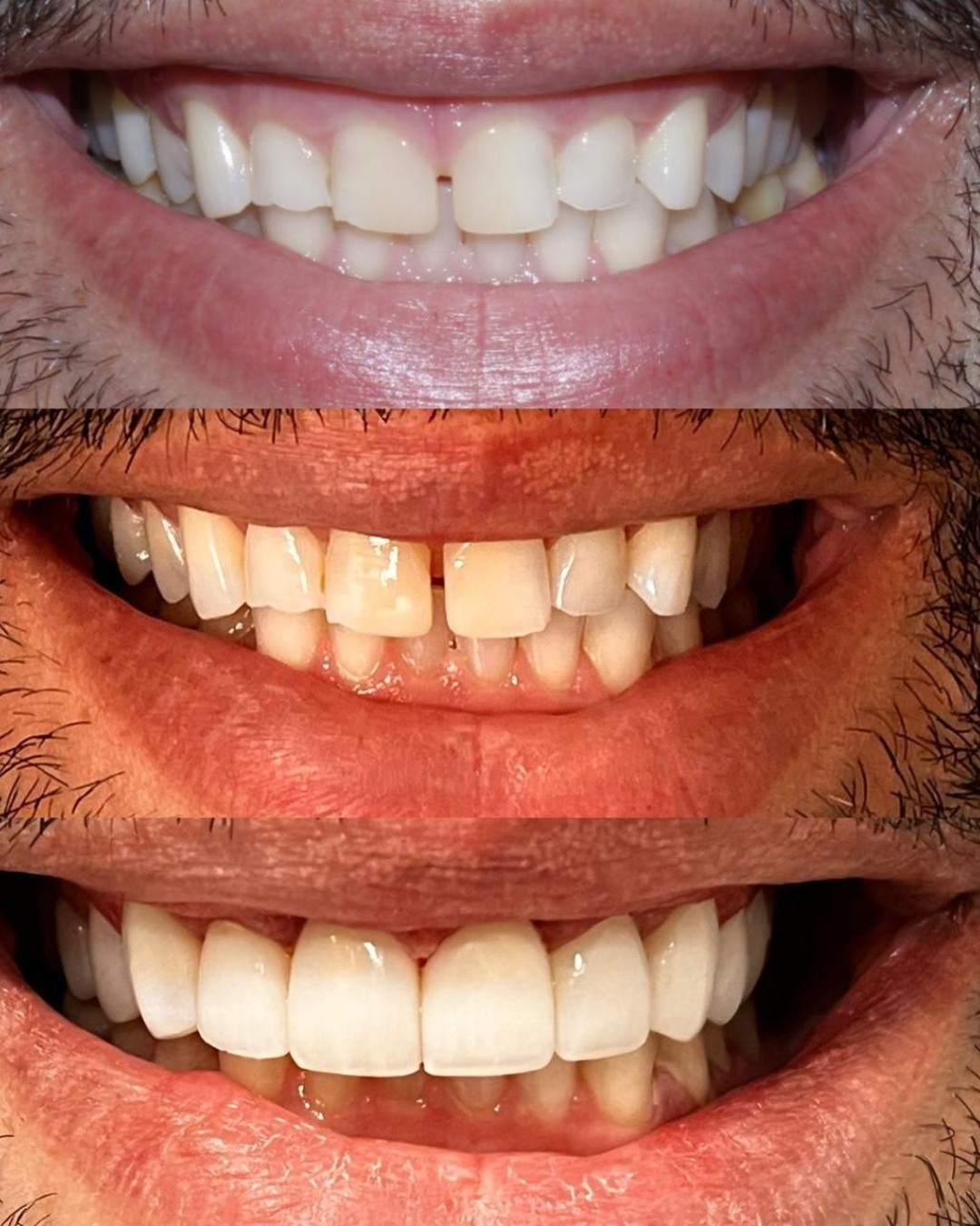 Lentes ImplanTOP (4)